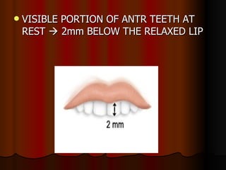 VISIBLE PORTION OF ANTR TEETH AT REST    2mm BELOW THE RELAXED LIP 