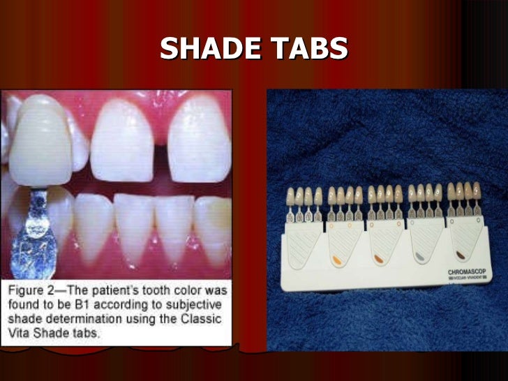 anterior tooth selection