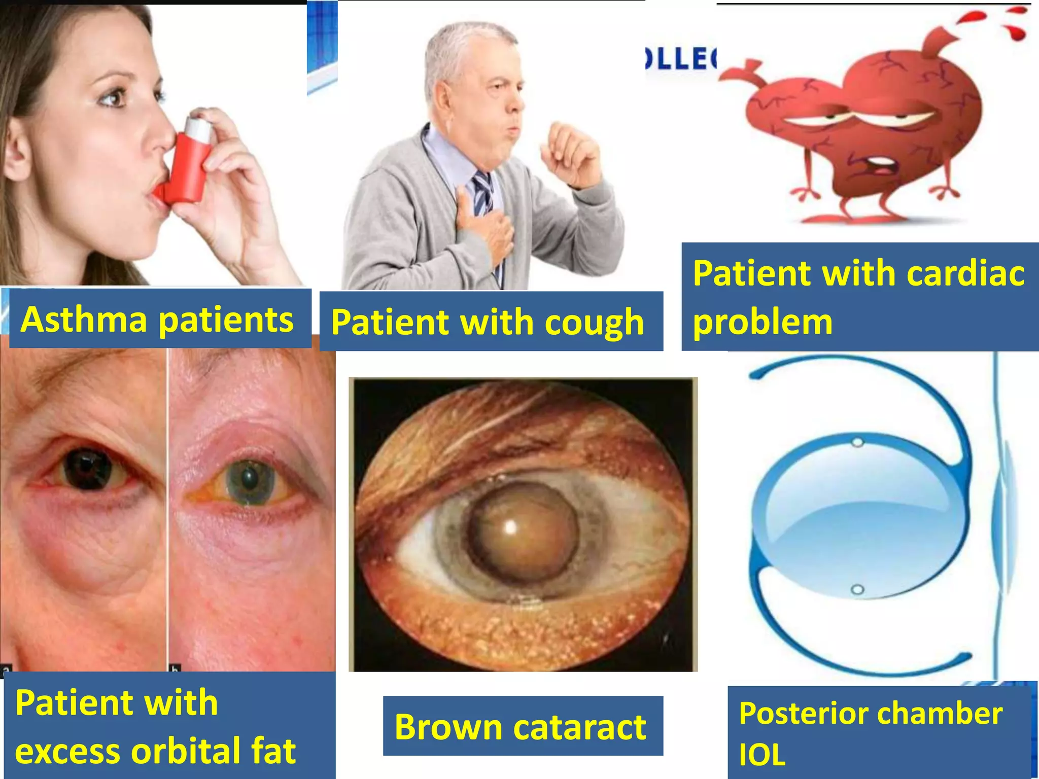 Intracapsular Cataract extraction