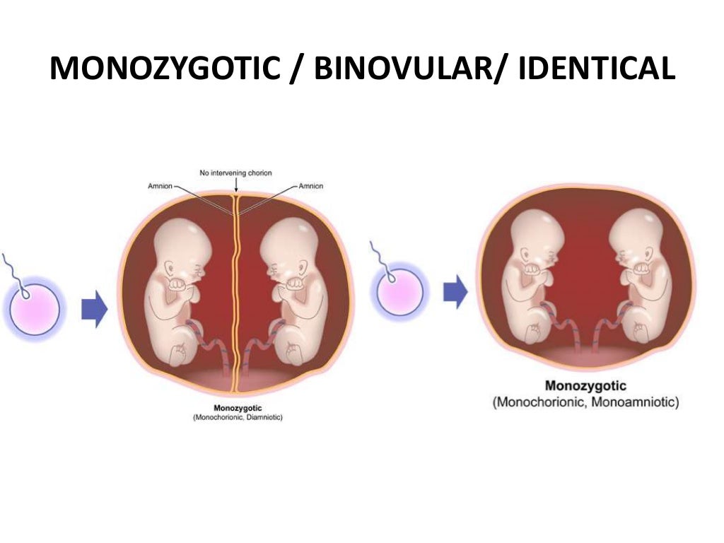 Multiple Pregnancy Diagnosis ,Clinical Features & Complications
