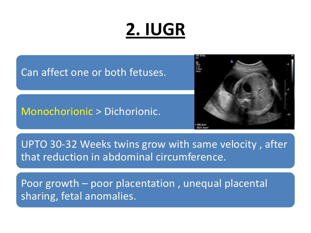 Multiple Pregnancy Diagnosis ,Clinical Features & Complications