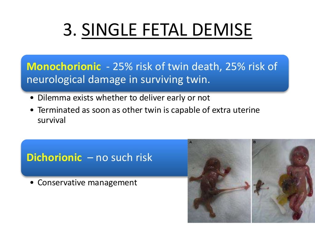 Multiple Pregnancy Diagnosis ,Clinical Features & Complications