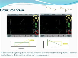 Flow/Time Scalar The decelerating flow pattern may be preferred over the constant flow pattern. The same tidal volume is delivered, but with a lower peak pressure.  