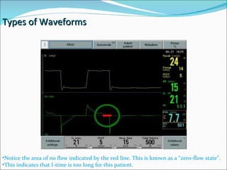 Notice the area of no flow indicated by the red line. This is known as a “zero-flow state”.  This indicates that I-time is too long for this patient. Types of Waveforms  