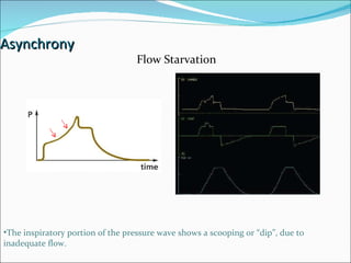 Asynchrony Flow Starvation The inspiratory portion of the pressure wave shows a scooping or “dip”, due to inadequate flow. 