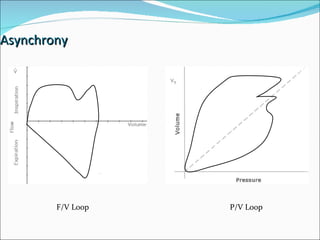 Asynchrony F/V Loop P/V Loop 