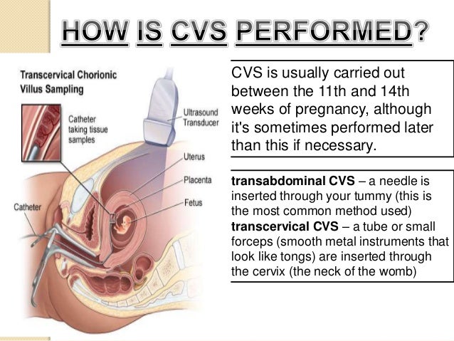 chorionic villus sampling chorionic villus sampling