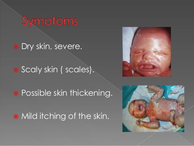 Harlequin syndrome