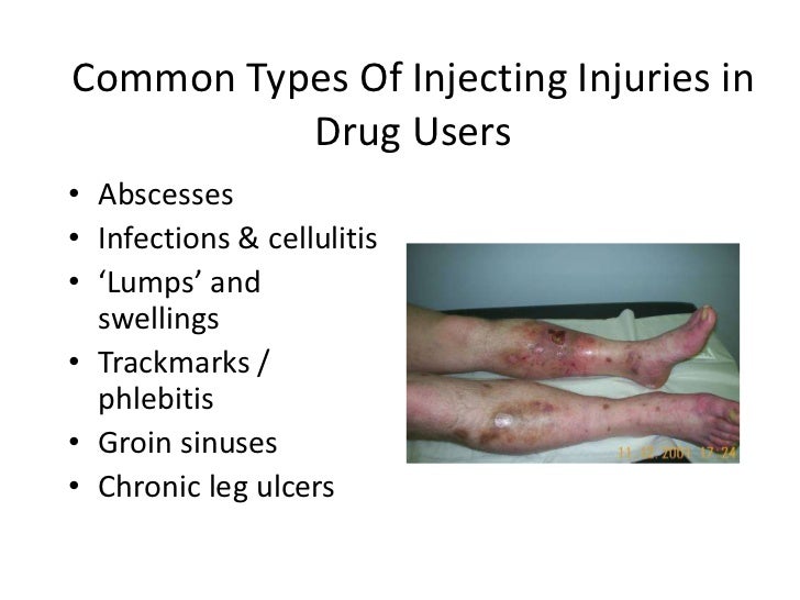 what is cellulitis and abscess of leg what is cellulitis and abscess of leg