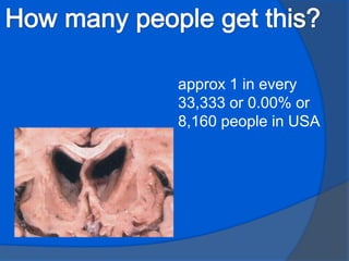  Dementia slowly gets worse