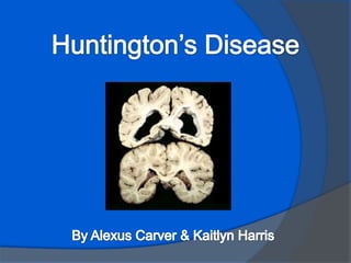 Huntington’s Disease By Alexus Carver & Kaitlyn Harris 