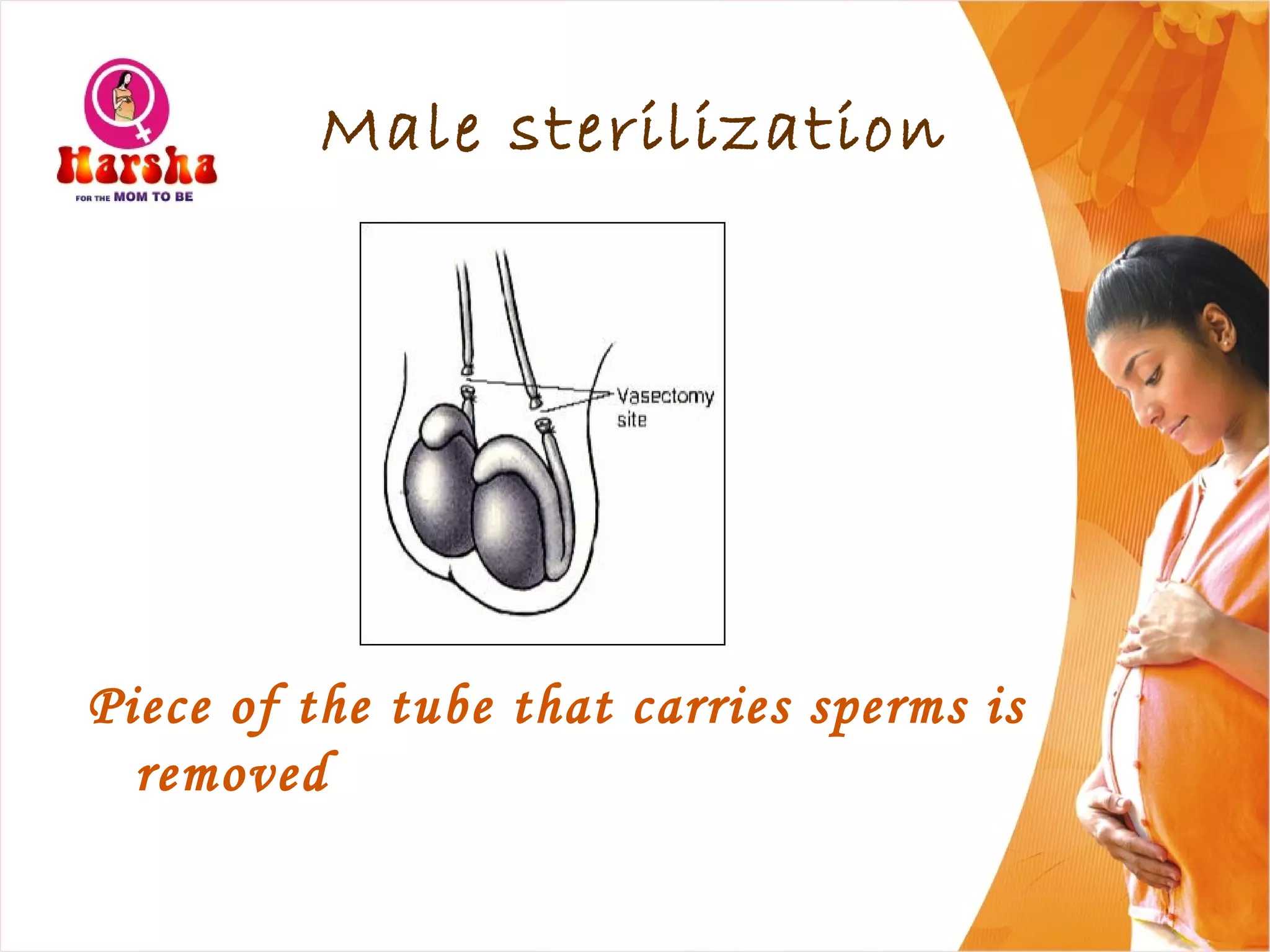 Male sterilization
Piece of the tube that carries sperms is
removed
 