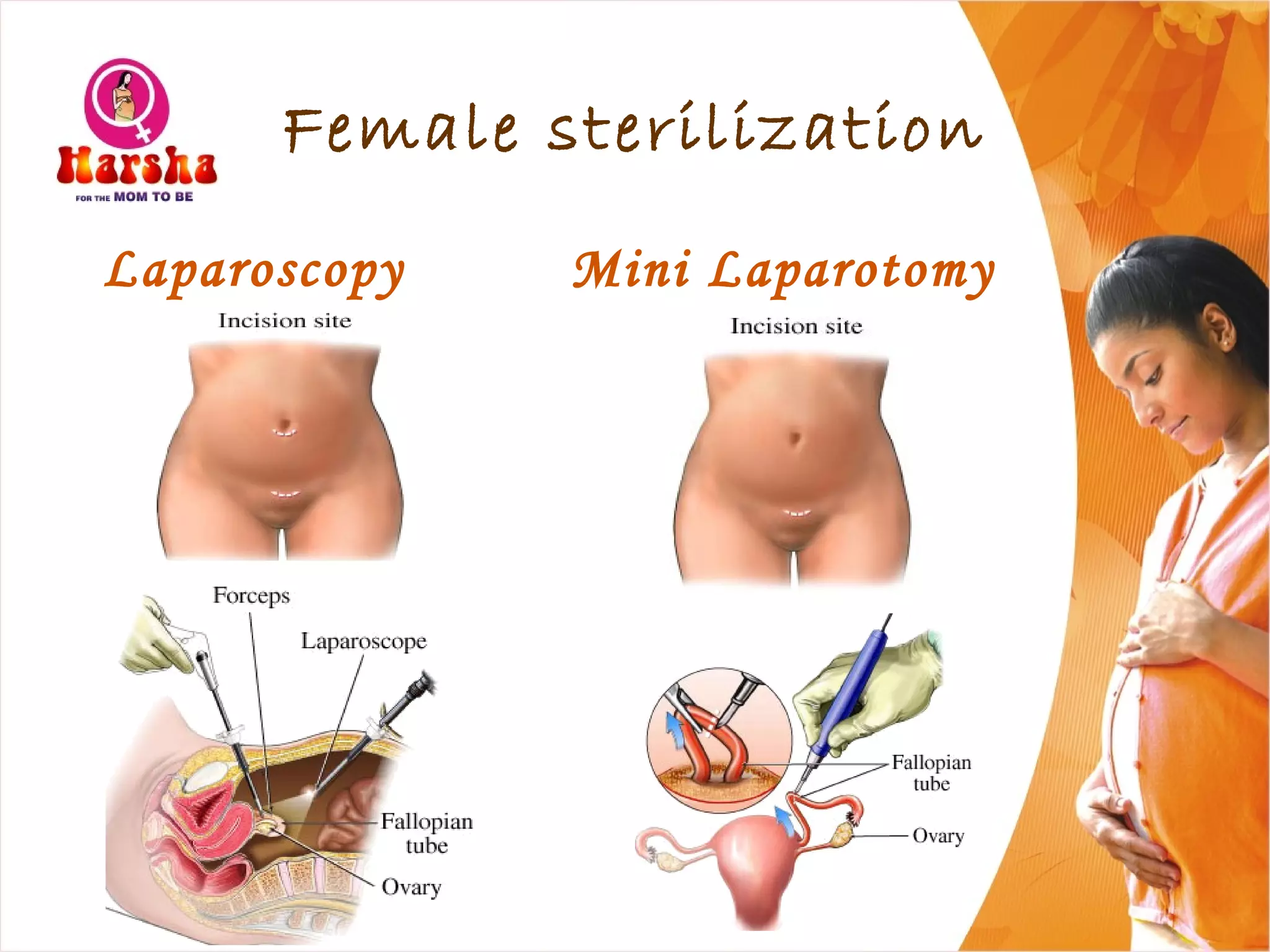 Female sterilization
Laparoscopy Mini Laparotomy
 