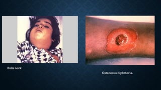 Bulls neck
Cutaneous diphtheria.
 