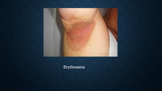 Erythrasma
 