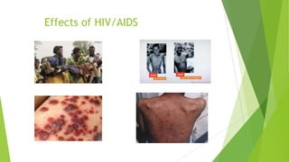 HIV/AIDS | PPT