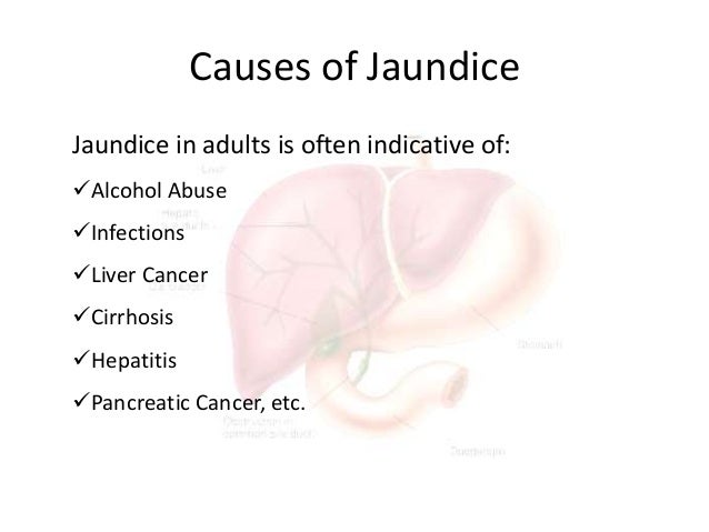 Natural Remedies For Jaundice In Adults Natural Remedies For Jaundice In Adults