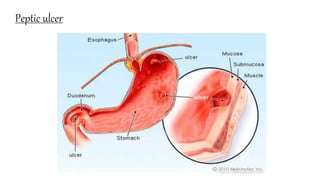 Peptic ulcer
 
