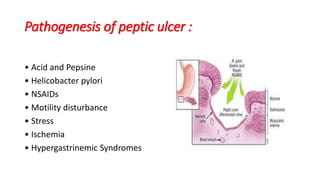 Pathogenesis of peptic ulcer :
• Acid and Pepsine
• Helicobacter pylori
• NSAIDs
• Motility disturbance
• Stress
• Ischemia
• Hypergastrinemic Syndromes
 