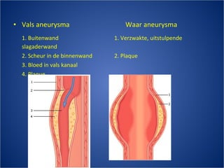 Vals aneurysma Waar aneurysma 1. Buitenwand 1. Verzwakte, uitstulpende slagaderwand 2. Scheur in de binnenwand 2. Plaque 3. Bloed in vals kanaal 4. Plaque 