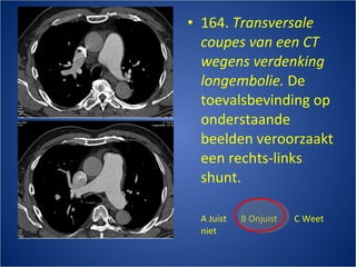 164.  Transversale coupes van een CT wegens verdenking longembolie.  De toevalsbevinding op onderstaande beelden veroorzaakt een rechts-links shunt. A Juist B Onjuist C Weet niet  