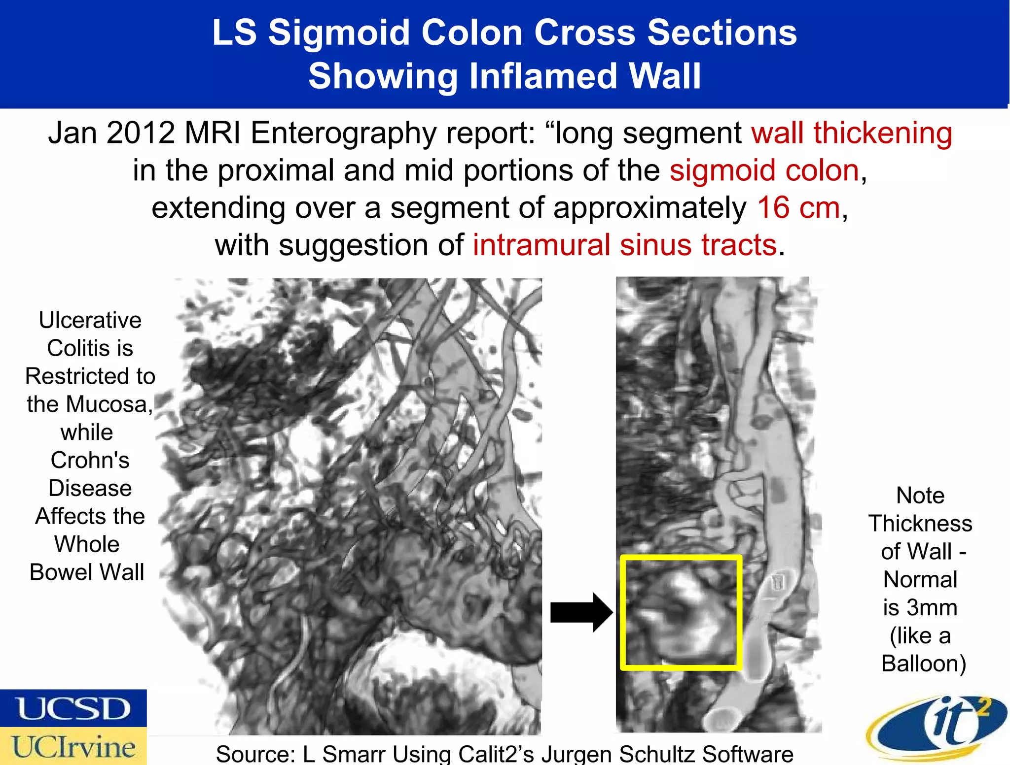 LS Sigmoid Colon Cross Sections
                     Showing Inflamed Wall
  Jan 2012 MRI Enterography report: “long segment wall thickening
       in the proximal and mid portions of the sigmoid colon,
         extending over a segment of approximately 16 cm,
              with suggestion of intramural sinus tracts.

 Ulcerative
  Colitis is
Restricted to
the Mucosa,
    while
  Crohn's
  Disease                                                                   Note
 Affects the                                                             Thickness
   Whole                                                                  of Wall -
Bowel Wall                                                                Normal
                                                                          is 3mm
                                                                           (like a
                                                                          Balloon)


                Source: L Smarr Using Calit2’s Jurgen Schultz Software
 