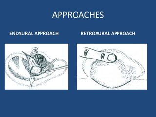 Harvesting cartilage for cartilage tympanoplasty | PPSX