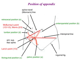 spine-navel
(Monroe’s) line
McBurney’s point
(1/2-1/3), Morris (2/3)
Lanz’s point (1/3)
ant. sup.
iliac spine
interspinal line
inguinal lig.
pelvic position (a)
anteroparietal position (b)
Ilioinguinal position (c)
lumbar position (d)
retrocecal position (e)
Position of appendix
 