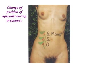 Change of
position of
appendix during
pregnancy
 
