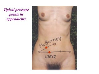 Tipical pressure
points in
appendicitis
 
