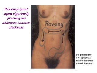 Rovsing-signal:
upon vigorously
pressing the
abdomen counter-
clockwise,
the pain felt on
the appendix
region becomes
more intensive.
 