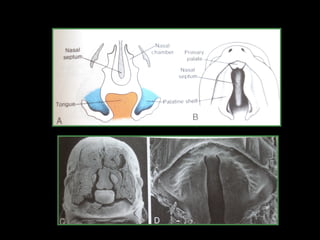 Development of cleft lip and palate.pptx