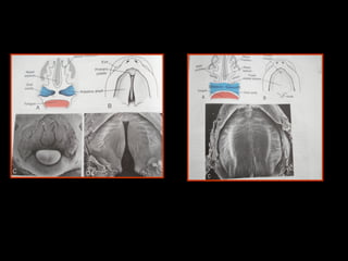 Development of cleft lip and palate.pptx