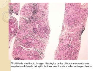 EXAMENES PARACLINICOSSe halló un bocio clínico pequeño y no doloroso, pero la captación de I radioactivo 131 realizada después de la supresión de la lactancia fue baja (10,2% a 48 horas). Se llegó con esto al diagnóstico presuntivo de tiroiditis, probablemente subaguda, postulándose que probablemente los anticuerpos fueron bajos debido a su inicio tardío, en el posparto mediato. Se tuvo presente la enfermedad de Graves, pero la regresión espontánea hacia el hipotiroidismo alejó el diagnóstico.