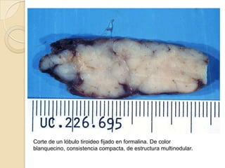 RODRIGUEZ SAGASTEGUI, Julio OrlandoHISTORIA CLINICAPaciente de 31 años, de raza blanca, primigrávida, que gesta a consecuencia de inseminación con esperma homólogo, debido a oligoovulaciones y ovarios poliquísticos, con leve androgenización. Se adoptó el régimen con FSH recombinante (Fostimón, Lab IBSA) 150 UI por vía intramuscular, en los días 8, 10 y 12 del ciclo, seguido de 5 000 UI de gonadotrofina coriónica (Pregnyl, Lab. Organon), cuando los folículos dominantes alcanzaron ecográficamente los 20 mm de diámetro. En la tercera inseminación se logró la gestación.