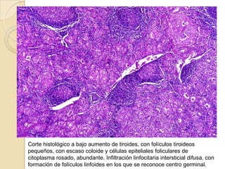 Padecimiento actualEntre los antecedentes familiares había historia de hipotiroidismo materno, así como en otros miembros de esta línea.El embarazo procedió sin complicaciones en el desarrollo fetal, pese a una leve preeclampsia después de la semana 28. El feto fue diagnosticado como de sexo masculino, dato de importancia, debido a que se ha reportado incidencias mayores de tiroiditis posparto cuando las madres son portadoras de estos fetos. El parto se realizó por cesárea, obteniéndose un feto de sexo masculino, de 3,600 g, con Apgar de 9/10.La lactancia transcurrió sin alteraciones hasta el tercer mes, cuando la madre comenzó a quejarse de sudoraciones "pastosas", oleadas de calor, palpitaciones frecuentes e insomnio. Conjuntamente, notó disminución en el peso corporal.