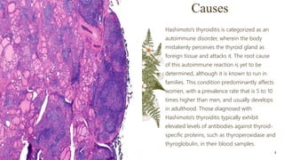 Causes
Hashimoto's thyroiditis is categorized as an
autoimmune disorder, wherein the body
mistakenly perceives the thyroid gland as
foreign tissue and attacks it. The root cause
of this autoimmune reaction is yet to be
determined, although it is known to run in
families. This condition predominantly affects
women, with a prevalence rate that is 5 to 10
times higher than men, and usually develops
in adulthood. Those diagnosed with
Hashimoto's thyroiditis typically exhibit
elevated levels of antibodies against thyroid-
specific proteins, such as thyroperoxidase and
thyroglobulin, in their blood samples.
Presentation title 4
 