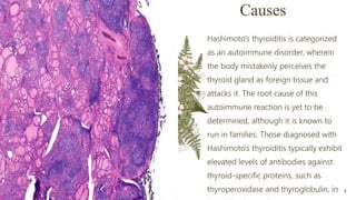 Causes
Hashimoto's thyroiditis is categorized
as an autoimmune disorder, wherein
the body mistakenly perceives the
thyroid gland as foreign tissue and
attacks it. The root cause of this
autoimmune reaction is yet to be
determined, although it is known to
run in families. Those diagnosed with
Hashimoto's thyroiditis typically exhibit
elevated levels of antibodies against
thyroid-specific proteins, such as
thyroperoxidase and thyroglobulin, in
Presentation title 4
 