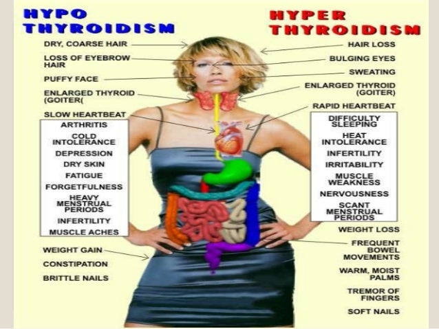 Hashimotoâs thyroiditis