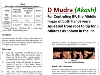 D Mudra (Akash)
For Controling BP, the Middle
finger of both hands were
squeezed from root to tip for 5
Minutes as Shown in the Pic.
 
