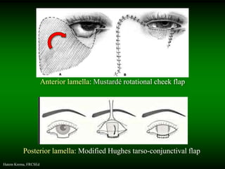 Large Rotation Flap Hatem Krema - Ocular Oncology Surgeries | PPSX