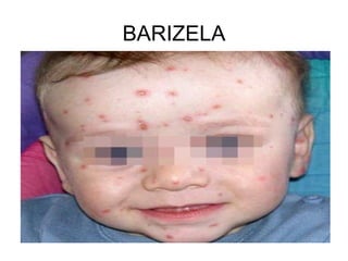 BARIZELA 