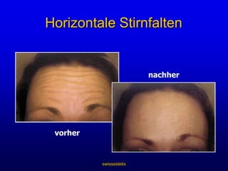 swissestetixWirkmechanismus von BotoxWie wirkt es?Botox bindet zunächst an die präsynaptische cholinerge NervenendigungBotulinumtoxin Typ ALeichtkette    -   SchwerketteDisulfidbindungEndplattenregion