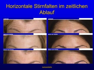 swissestetixWirkmechanismus von BotoxWie wirkt es?Botox wird über Rezeptor-vermittelte Endozytose aufgenommenBotulinumtoxin Typ A gelangt in die NervenendigungAcetylcholin-FreisetzungMuskel