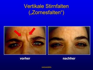swissestetixWirkmechanismus von BotoxWie wirkt es?Wenn es in der Zelle ist, blockiert Botox die Freisetzung des Neurotransmitters AcetylcholinDies bewirkt eine funktionelle DenervationBotulinumtoxin Typ A wirkt im Nerv und blockiert die Acetylcholin-FreisetzungMuskel