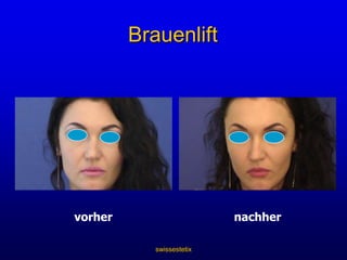 swissestetixWirkmechanismus von Botox 4Stimulation und Bildung von neuen Nervenverzwei-gungen1Bindung des Wirkstoffs an den Nervenenden zu den Muskel-/ Drüsen-verbindungen5Wiederherstellung der Muskel-/Drüsen-Nervenverbindungen nach 3 bis 4 Monaten2Aufnahme des Wirkstoffs3Verhinderung der Ausschwemmung der Botensubstanz Acetylcholin6Rückbildung der neuen Nervenver-bindung und Wieder-herstellung der alten