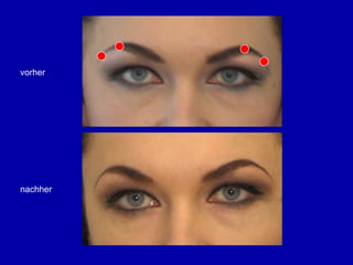 swissestetixBotox: Lifting-Effekt durch selektive MuskelhemmungStirnGlabella (Zornesfalten)AugenbrauenAugen (Krähenfüsse)Nase (Häschenfalten)WangeMund(Zahnfleischlächeln, Oberlippe, Unterlippe)Kinn (Kummerfalten, Pflastersteinkinn)Hals