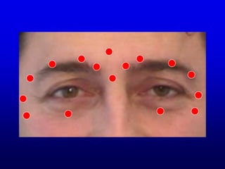 swissestetixHorizontale Stirnfaltennachhervorher