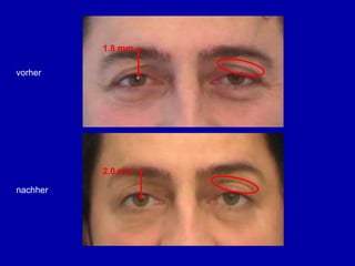 swissestetixVORHERNACH 30 TAGENNACH 120 TAGENHorizontale Stirnfalten im zeitlichen AblaufVORHERNACH 30 TAGENNACH 120 TAGEN