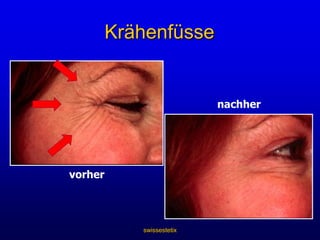 swissestetixVertikale Stirnfalten(„Zornesfalten“)vorhernachher